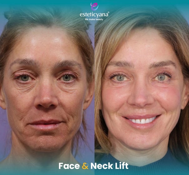 Face and neck lift before and after