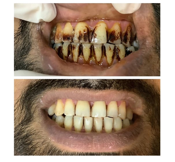 Teeth Cleaning