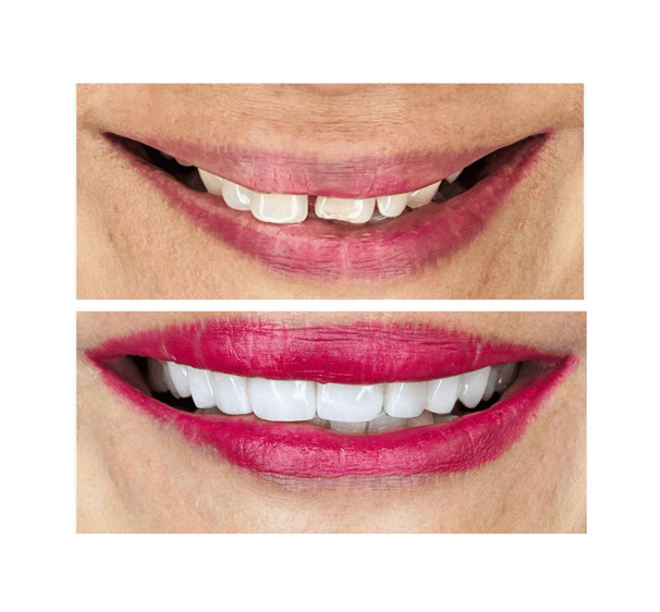 dental veneers