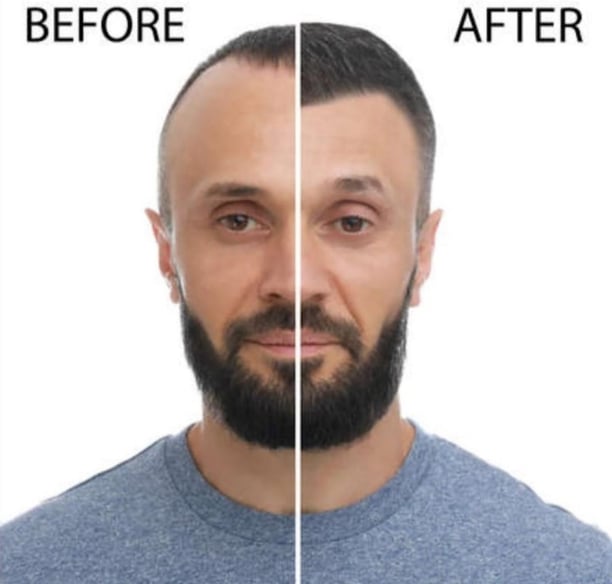 men hair patch