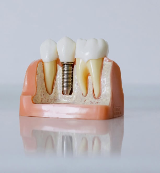 dent parodontale, saine, implant dentaire