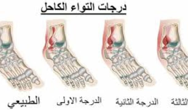 درجات التواء الكاحل