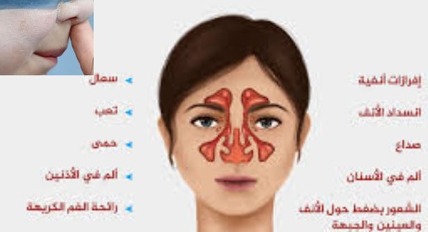 الحمى، القشعريرة، التعب، آلام العضلات، فقدان الشهية، الغثيان والقيء، الإسهال، السعا مشاكل نكش الانف