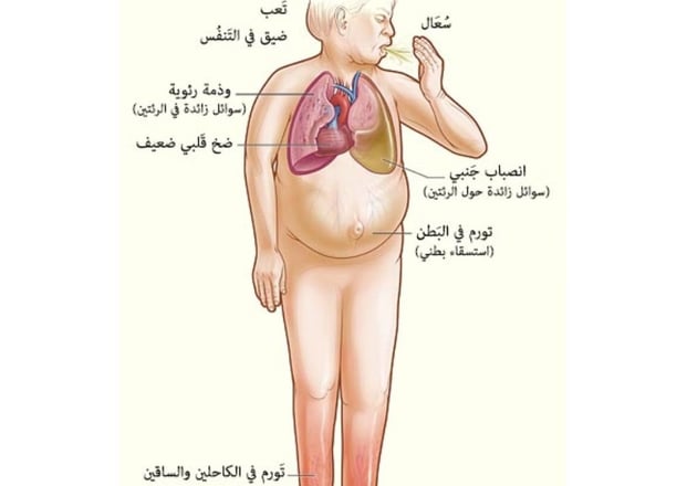 علامات امراض القلب