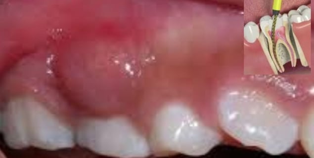 Dental Abscess