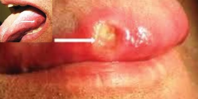Painful Dyspeptic Ulcer
