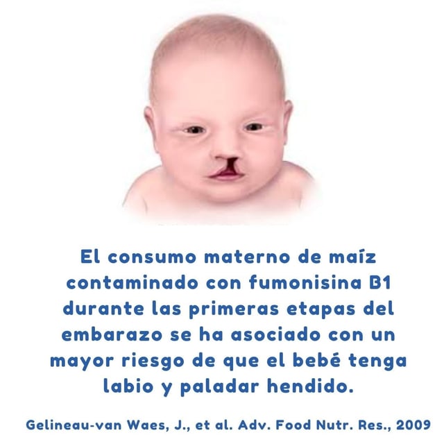 labio y paladar hendido