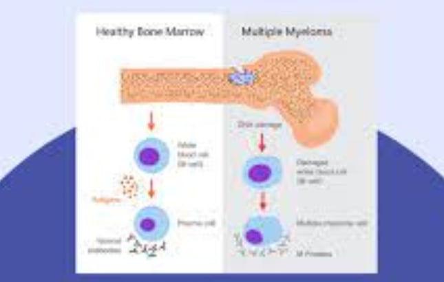 multip[e myeloma