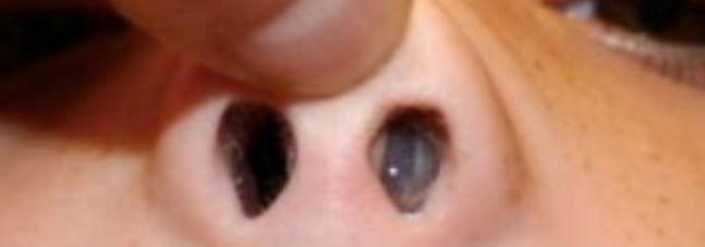 how to remove foreign body from the nose of a child