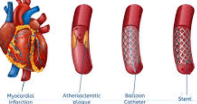 angioplasty