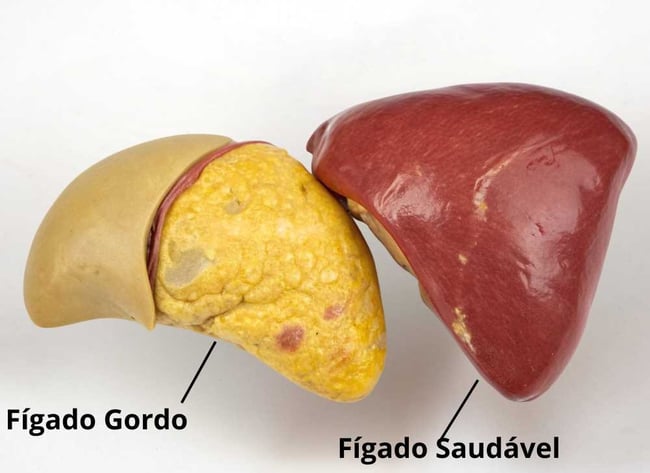 Comparação visual entre um fígado saudável e um fígado com esteatose hepática (gordura no fígado