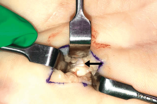Incisión de 1cm realizada para tratar el dedo en gatillo, la flecha muestra la polea A!