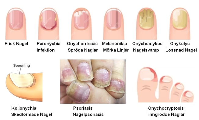 Nail Diseases