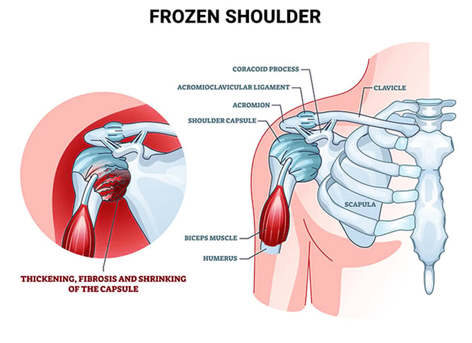 Best Shoulder Pain Treatment In Kochi, Kerala