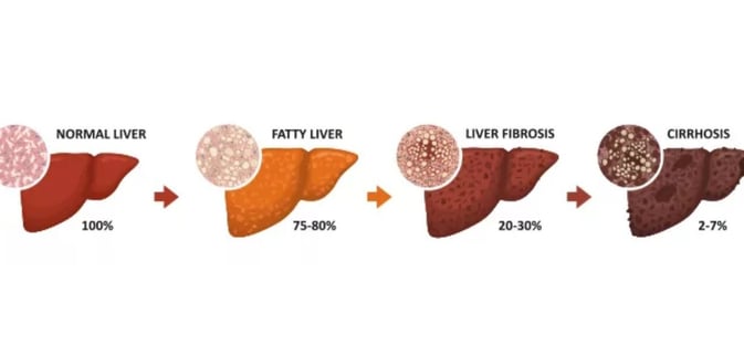 stages of fatty liver