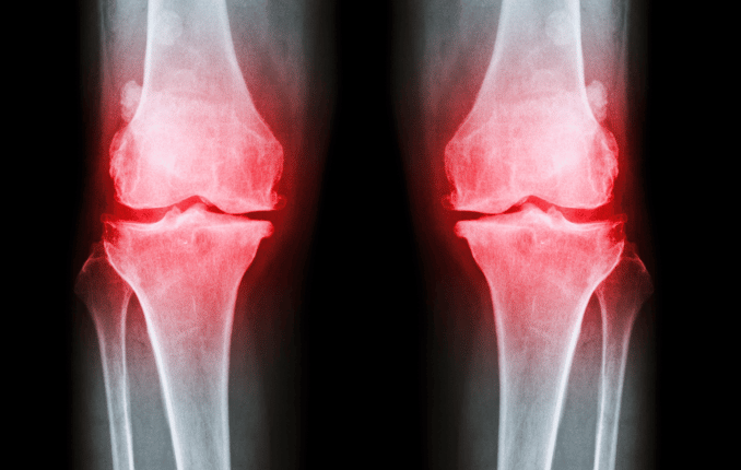 a pair of knee joint x ray image knee pain in OA