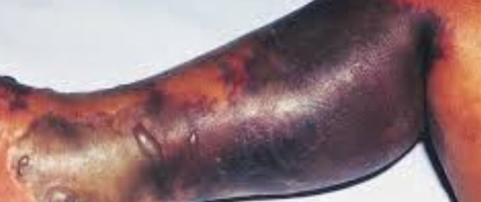 Necrotizing fasciitis Flesh-eating Fournier’s gangrene & novel treatment