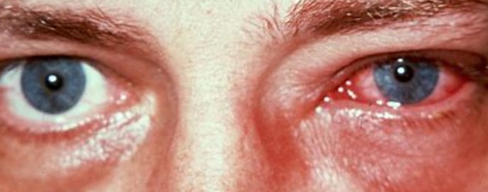 conjunctivitis