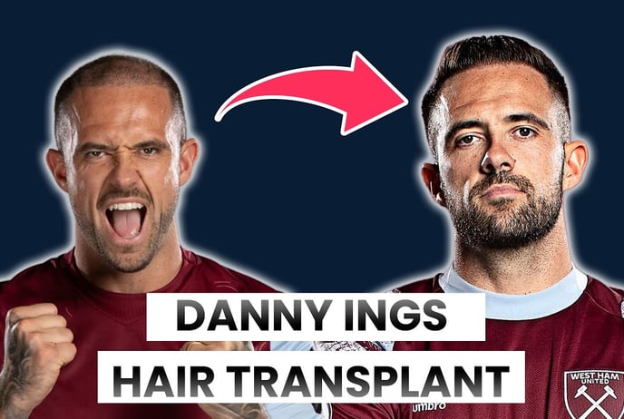 danny ings hair transplant