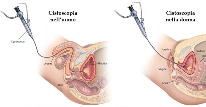 cistoscopia flessibile nell'uomo e nella donna