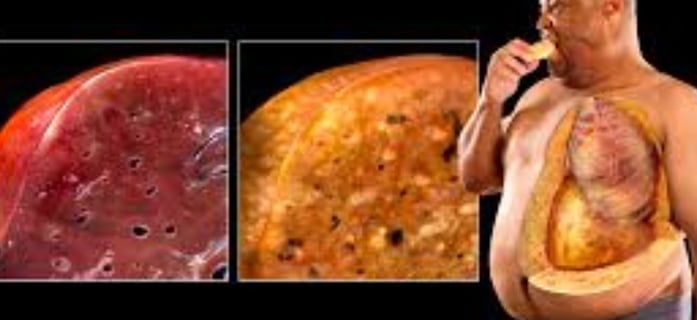 fatty liver more in obese patient 