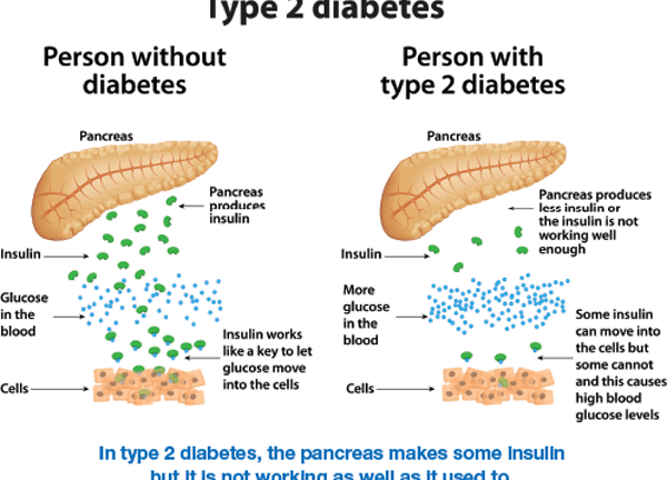 Type 2 diabetes