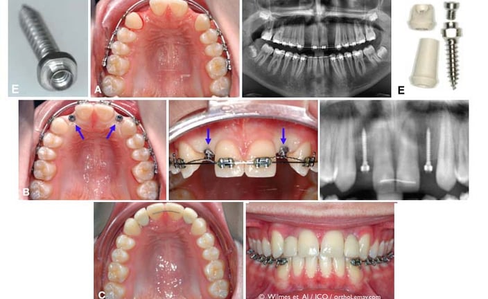 minivis orthodontie