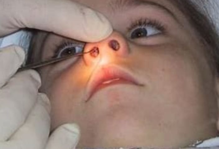 nasal f b removal 