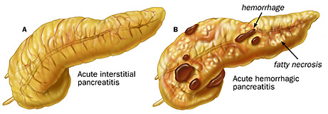 GASTRO FOUNDATION acute pancreatitis