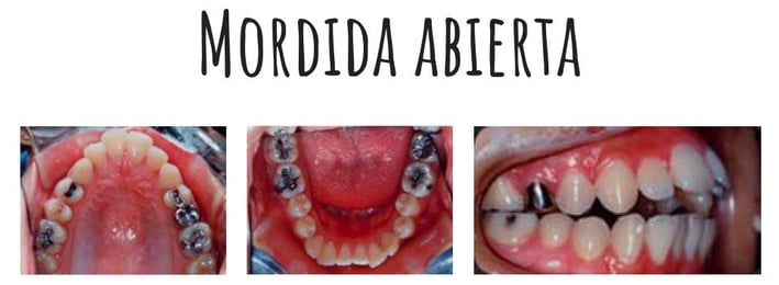 mordida abierta