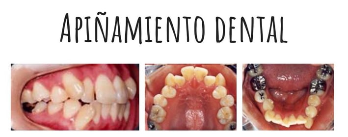 apiñamiento dental