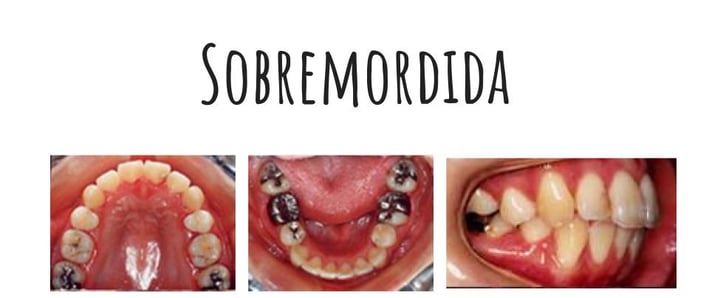 sobremordida