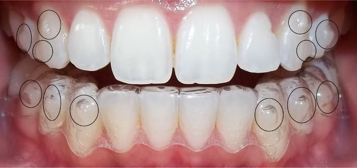 invisalign