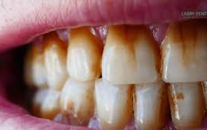 manchas en dientes