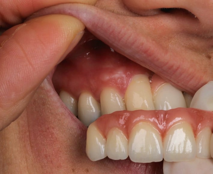 a person trying on dental implant models