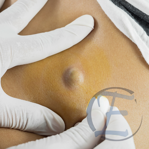 xérese de Cistos Sebáceos, Lipomas e Nevus Clinica ELITE
