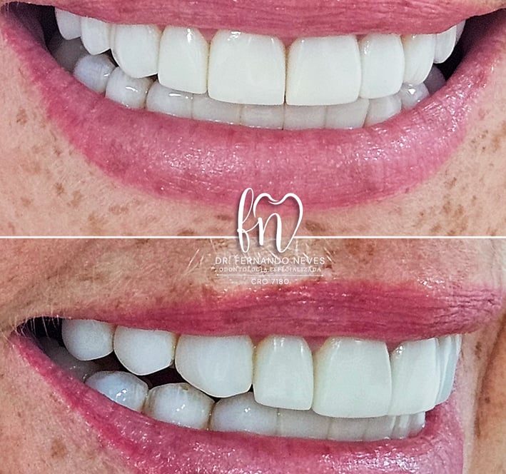 a before and after image of dental treatment