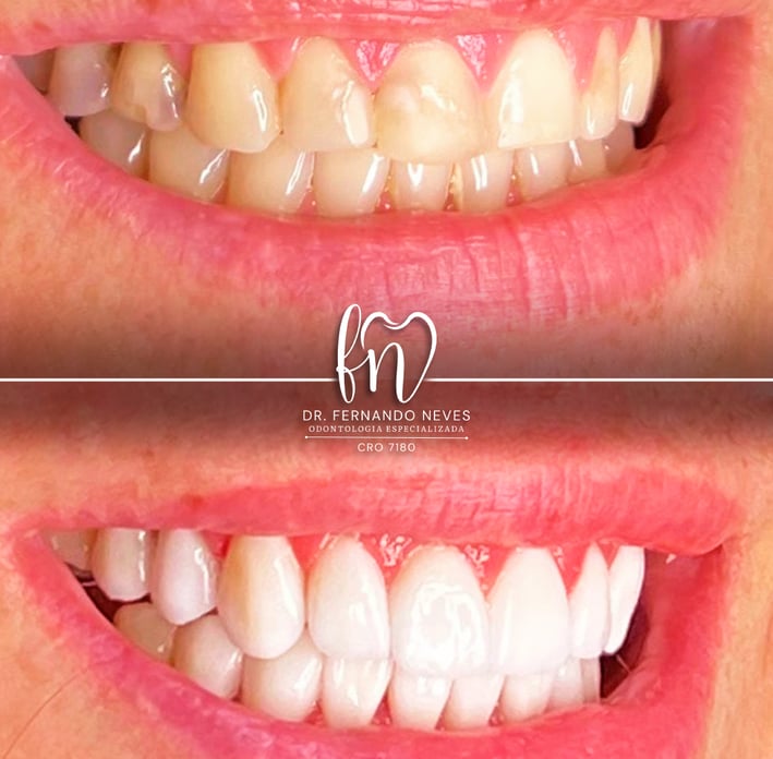 a before and after image of dental treatment