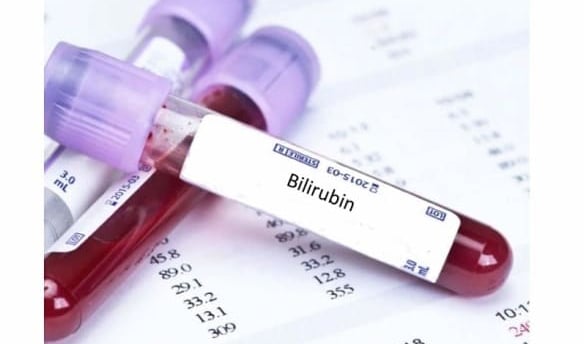 Bilirubin testi, karaciğer sağlığını değerlendirmek ve sarılık gibi hastalıkları teşhis etmek için kullanılan kan testi