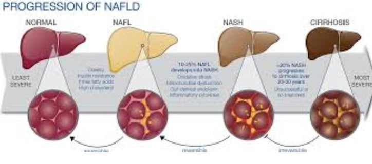 progression of liver fatty