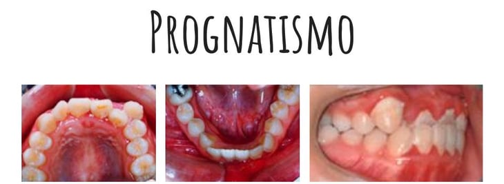 prognatismo mandibular