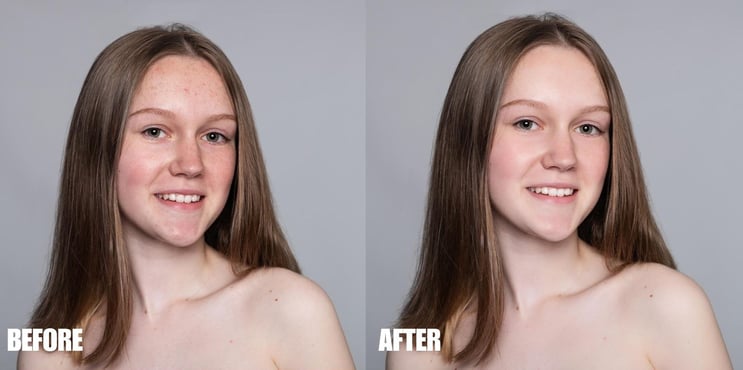 blemish-and-scar-removal