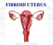 Fibroid Utersu