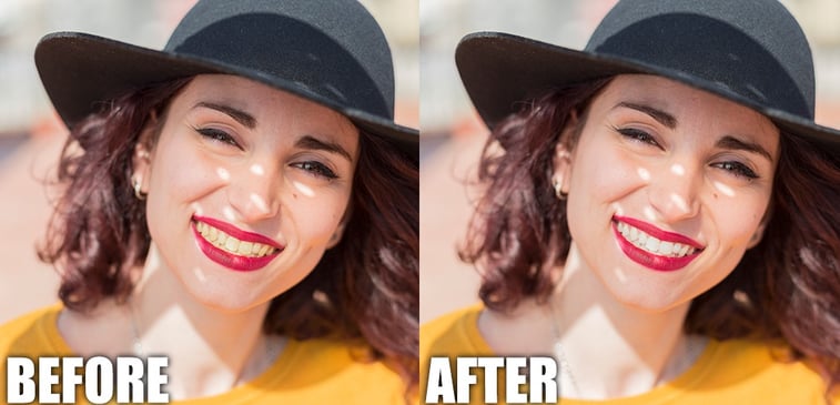 before and after teeth whitening fashion editing