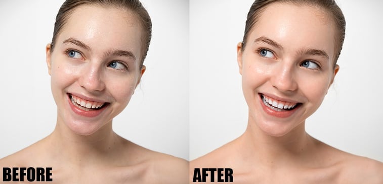 Teeth Whitening 