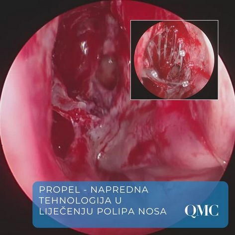 propel-implantat-operacija-sinusa-fess
