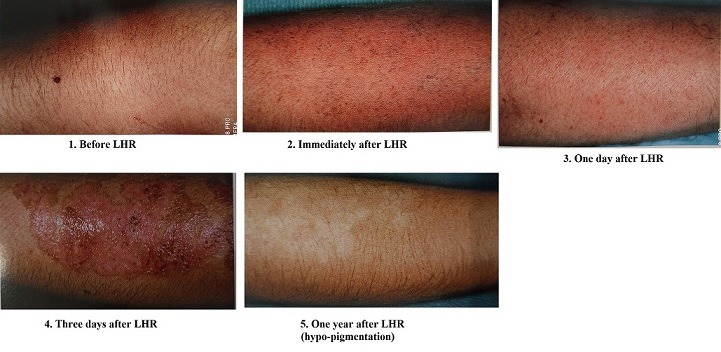 lhr-on-recent-sun-exposed-skin