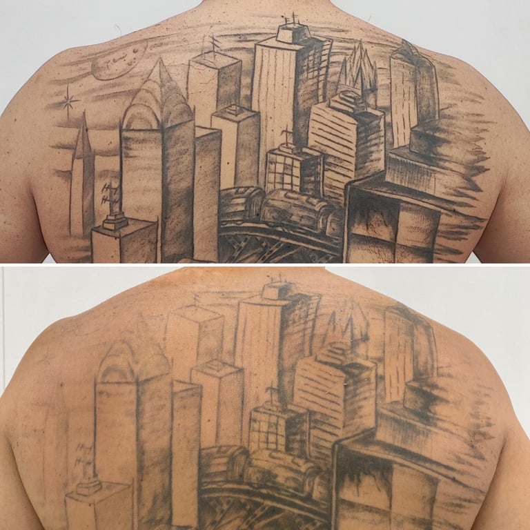 eliminación de tatuajes barcelona 