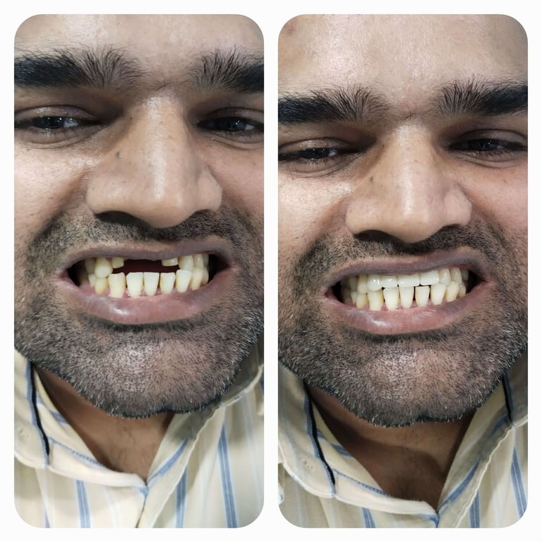 Zirconia Dental Bridge Before & After