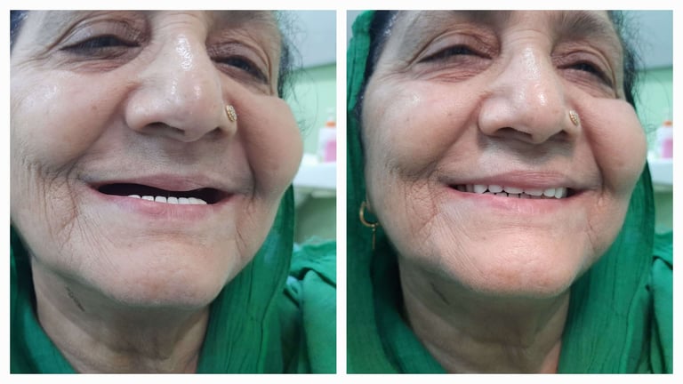 Before and After Picture of Complete Dentures Patient in Greater Noida